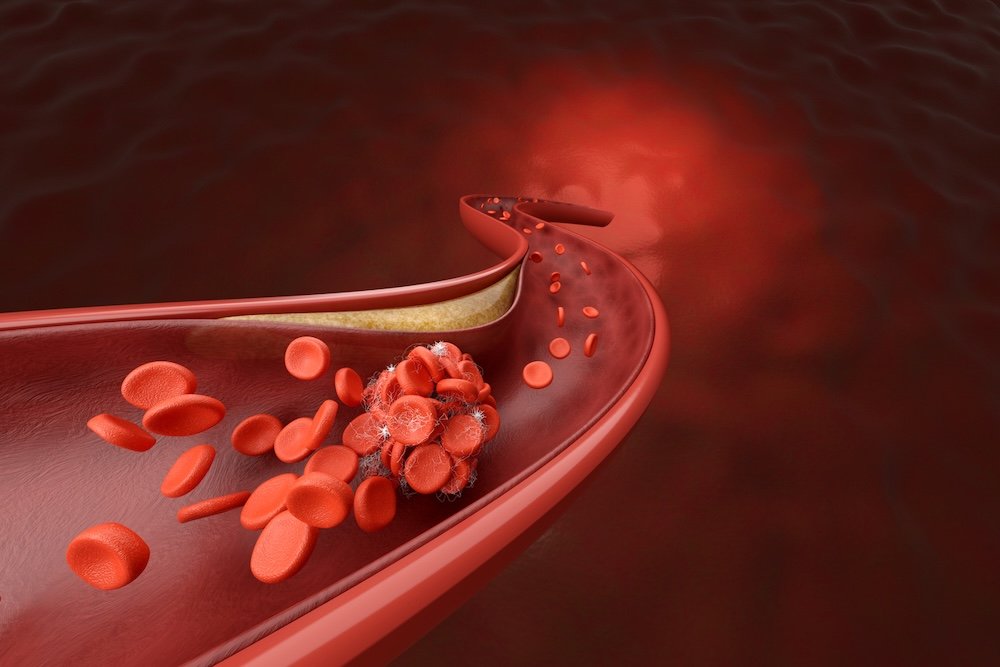 Blood Clots: Why They’re Dangerous and What to Watch For